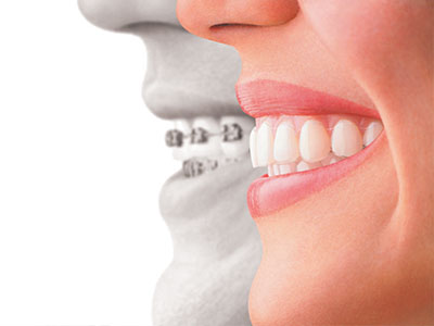 Rosenstein   Gartner Dentistry, PLLC | Crowns  amp  Onlays, Dental Implants   Restorations and Dental Bridges